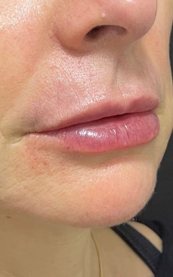 Depois do tratamento de Preenchimento Labial