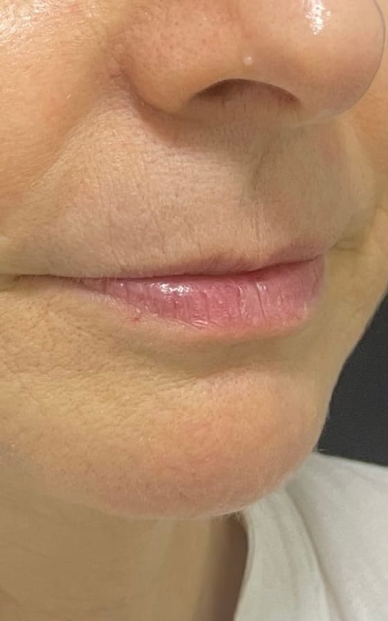 Preenchimento Labial, registro fotográfico 1