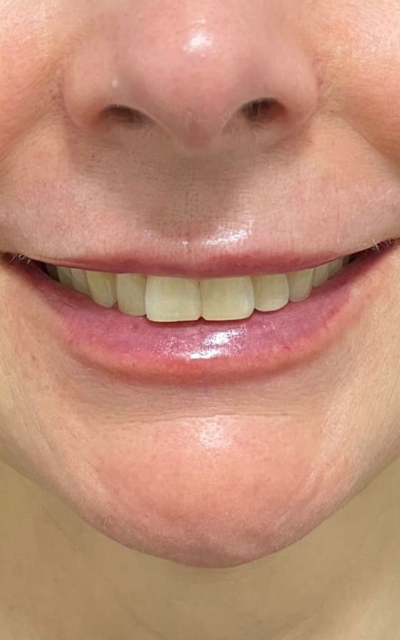 Depois do tratamento de Preenchimento Labial