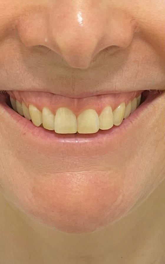 Preenchimento Labial, registro fotográfico 1