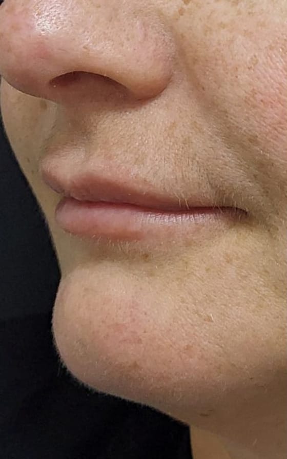 Antes do tratamento de Preenchimento Labial