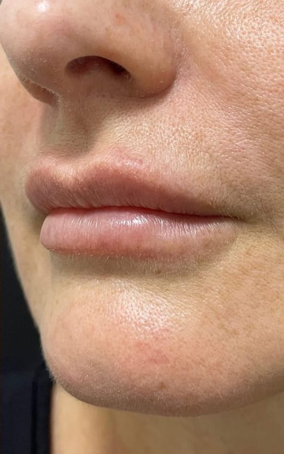 Preenchimento Labial, registro fotográfico 2