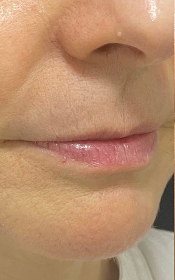 Preenchimento Labial, registro fotográfico 1