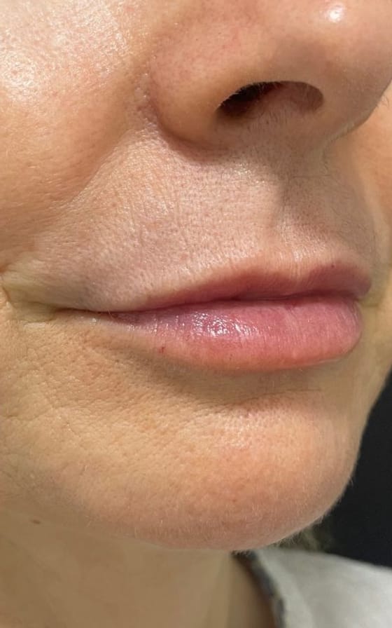 Preenchimento Labial, registro fotográfico 2