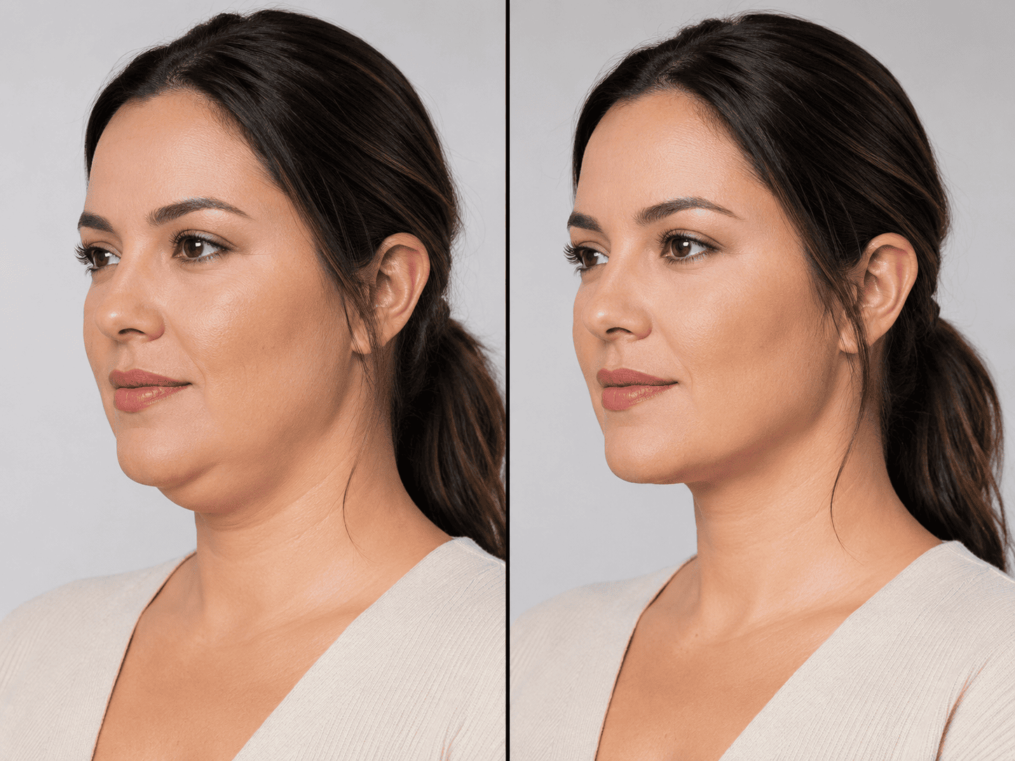 Redução de Gordura Localizada, procedimento realizado por dermatologista