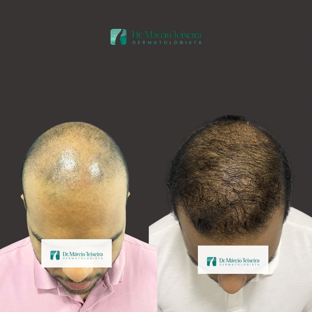 Antes e depois de tratamento da calvície, topo da cabeça