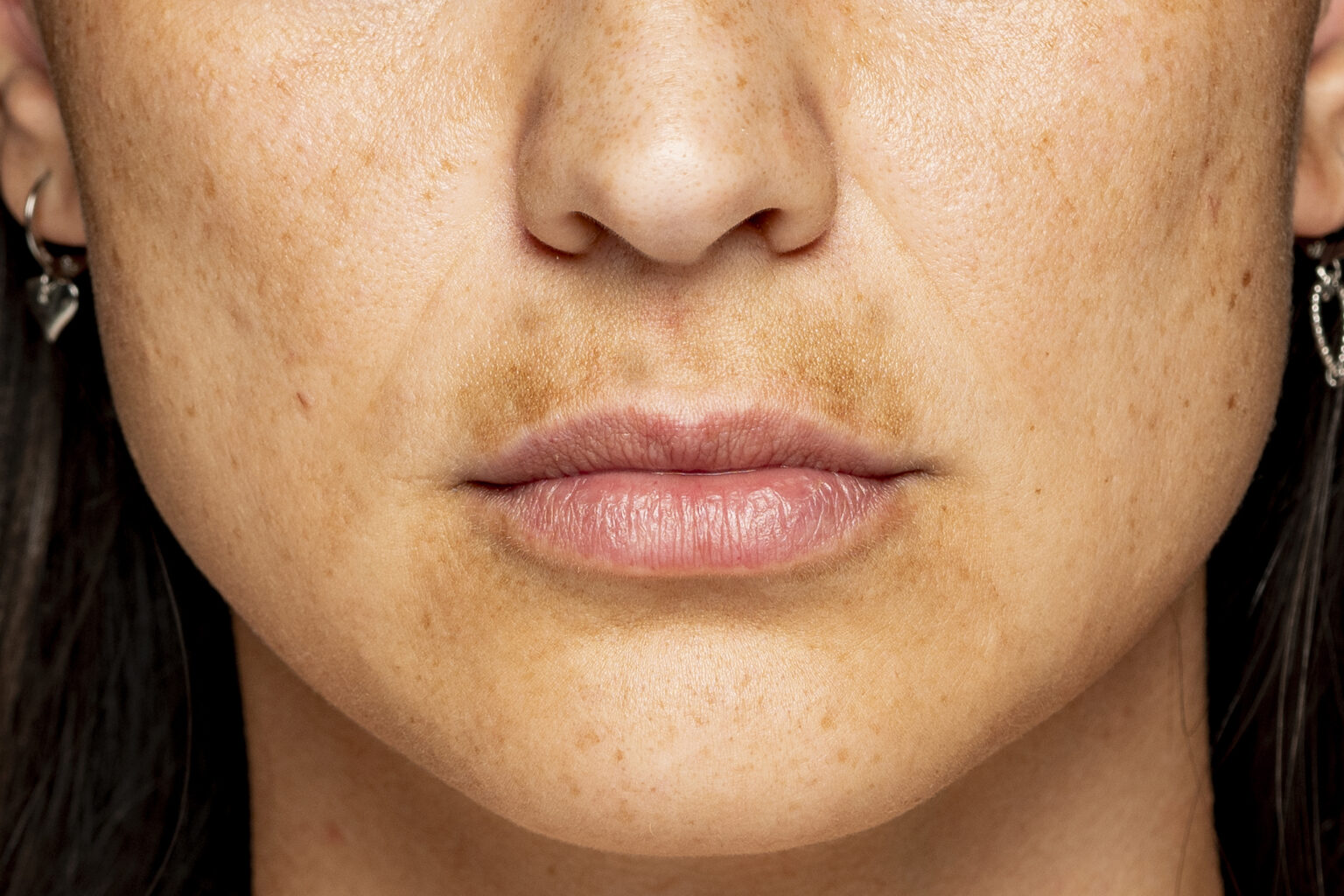 luz pulsada para melasma